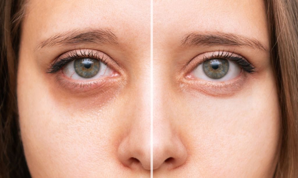 Cómo hacer la mejor mascarilla casera contra ojeras y bolsas